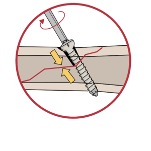 Curso de Diagnóstico y Tratamiento de Fracturas (12 meses de acceso)